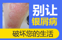 银屑病会给生活带来哪些严重的影响